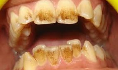 Kutagira isuku  yo  mu kanwa, kimwe  mu bituma  izi ndwara  ziganje mu bivuriza  mu mavuriro  mato n’ibitaro by’uturere